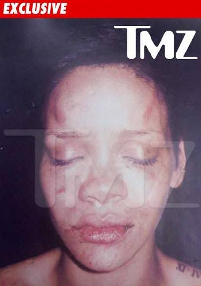 Rihanna Bruises