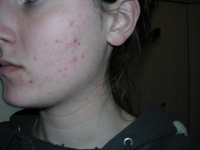 Acne01-28Leftside.jpg