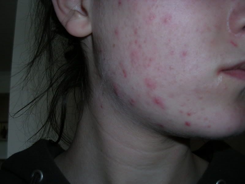 Acne01-28RightSide.jpg