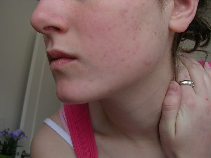 Acne03-18Leftside.jpg