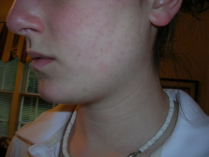 Acne06-26Leftside.jpg