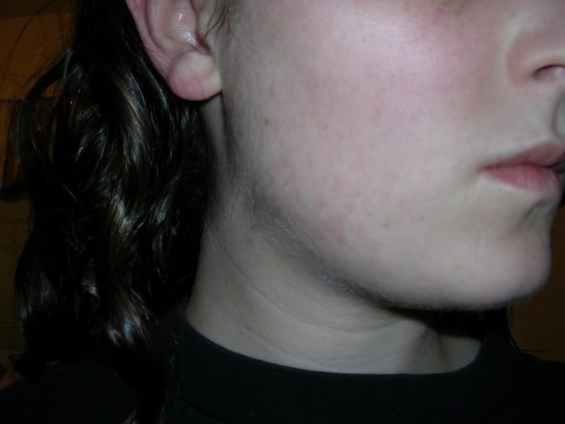 Acne07-17Rightside.jpg