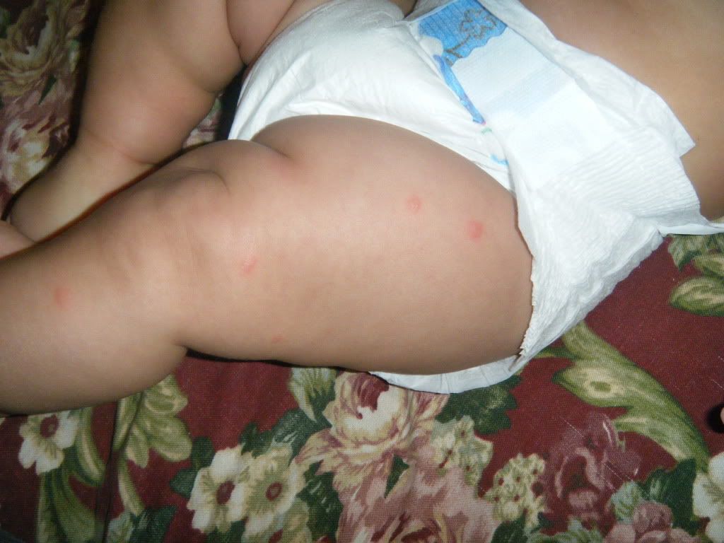 Bed Bug Bites On Babies Bug bites? rash? help!